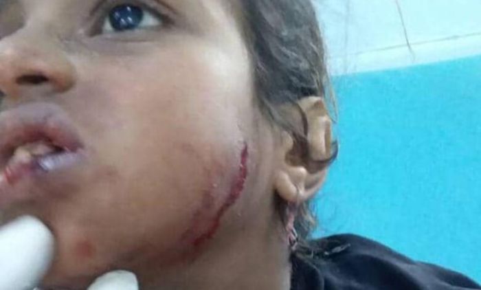 إصابة طفلة بشظية قذيفة حوثية استهدفت منطقة مكتظة بالسكان في الحديدة