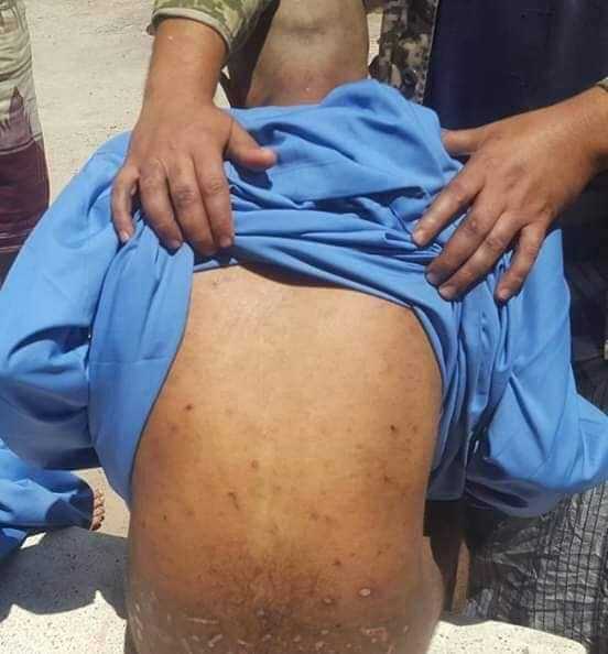 الأمراض الجلدية تفتك بالمختطفين في سجون المليشيا