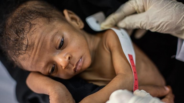 الخارجية البريطانيه: نصف الأطفال في اليمن يعانون من التقزم بسبب سوء التغذية